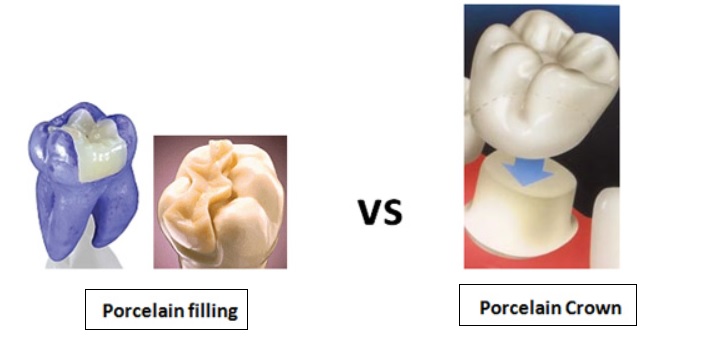 cerec filling