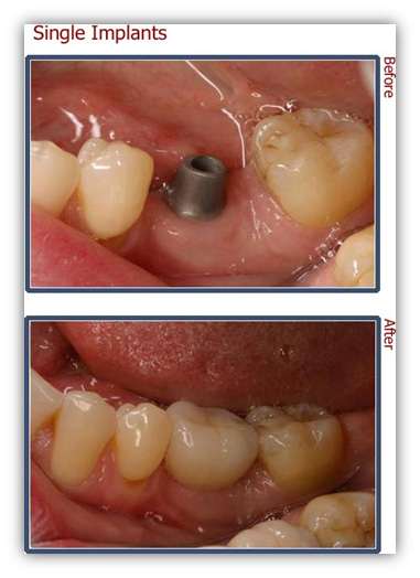 Single Implants - Professional Dental Implants in Sydney