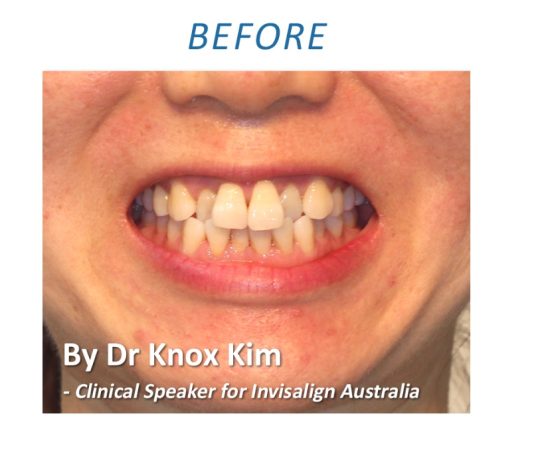 Orthodontic treatment Sydney CBD Before 3