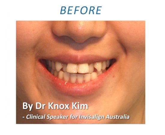 Orthodontic treatment Sydney Before 1