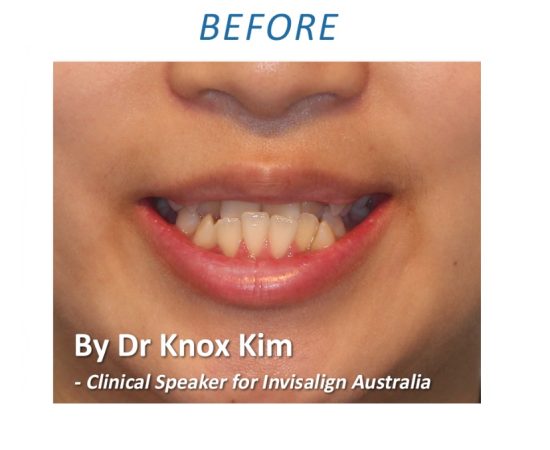 Orthodontic treatment Sydney CBD Before 1
