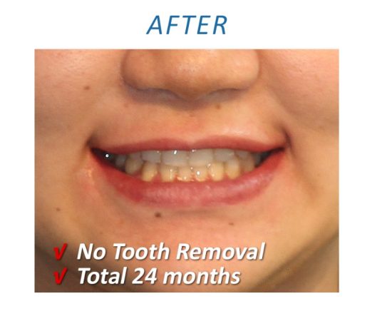 Orthodontic treatment Sydney After 2