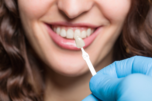 Dentist,Hand,Is,Using,Shade,Guide,At,Womans,Mouth,To