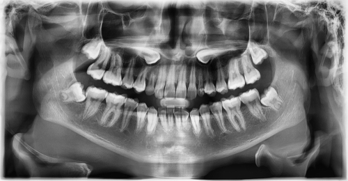 Panoramic,Radiograph,Show,Bilateral,Upper,Embedded,Canine,And,Both,Left