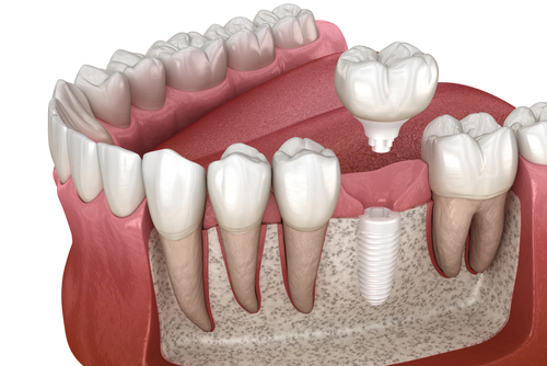 Molar,Tooth,Crown,Installation,Over,Ceramic,Implant.,Medically,Accurate,3d