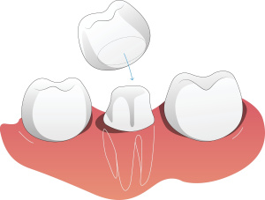Dental,Implant,Structure,Design,1