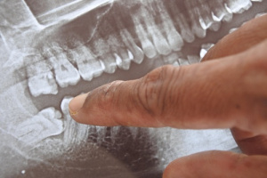 Panoramic,X-ray,Image,Of,Teeth,And,Mouth,With,Wisdom,Teeth,